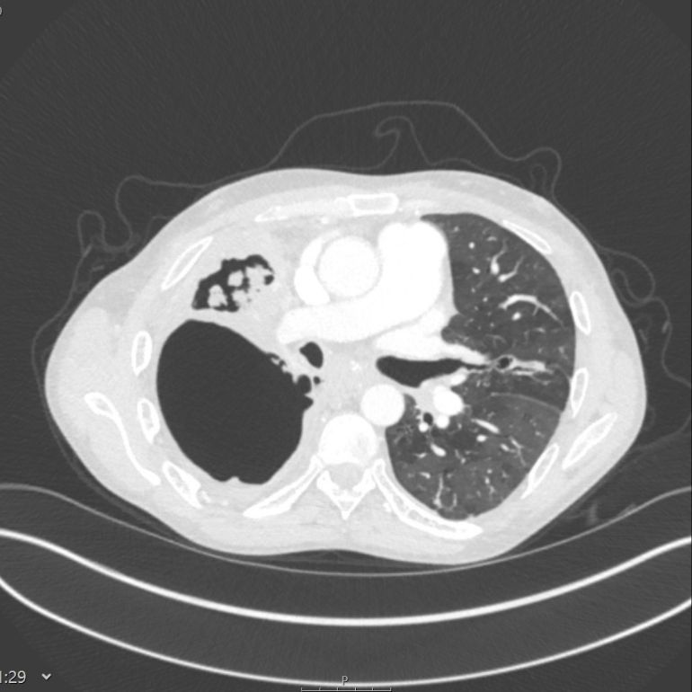 X-ray showing the lungs of a person with tuberculosis